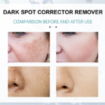 Dark Spot Corrector Remover Daily Face Serum - Image 2